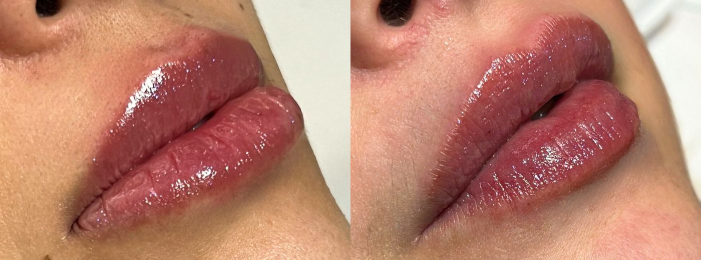 Preenchimento com 1ml de Ácido Hialurônico Rennova Lift® para Lábios ou Bigode Chinês!