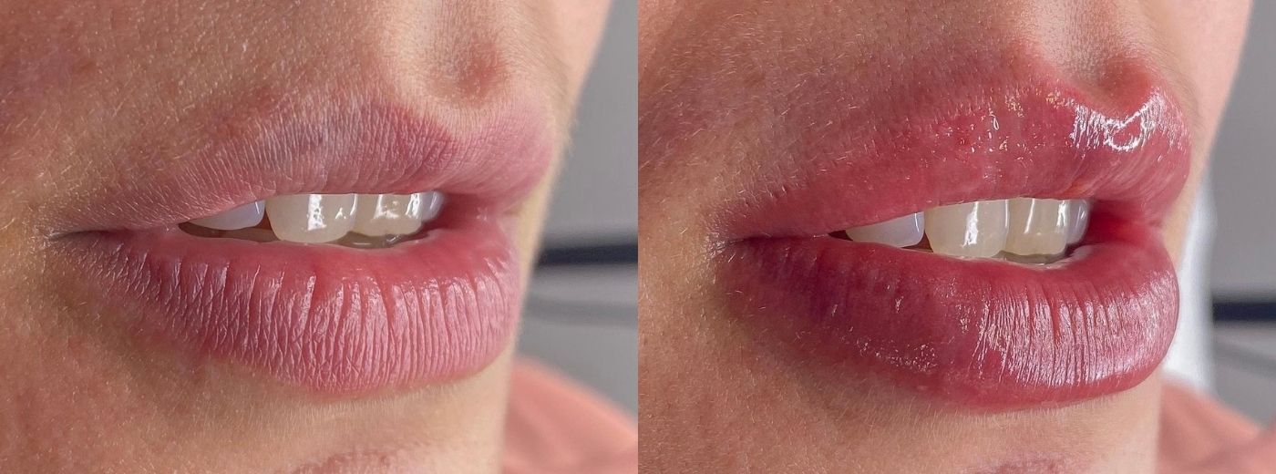Bio Lips + Retoque: Revitalização e Micropigmentação Labial suave sem marcar o contorno dos lábios