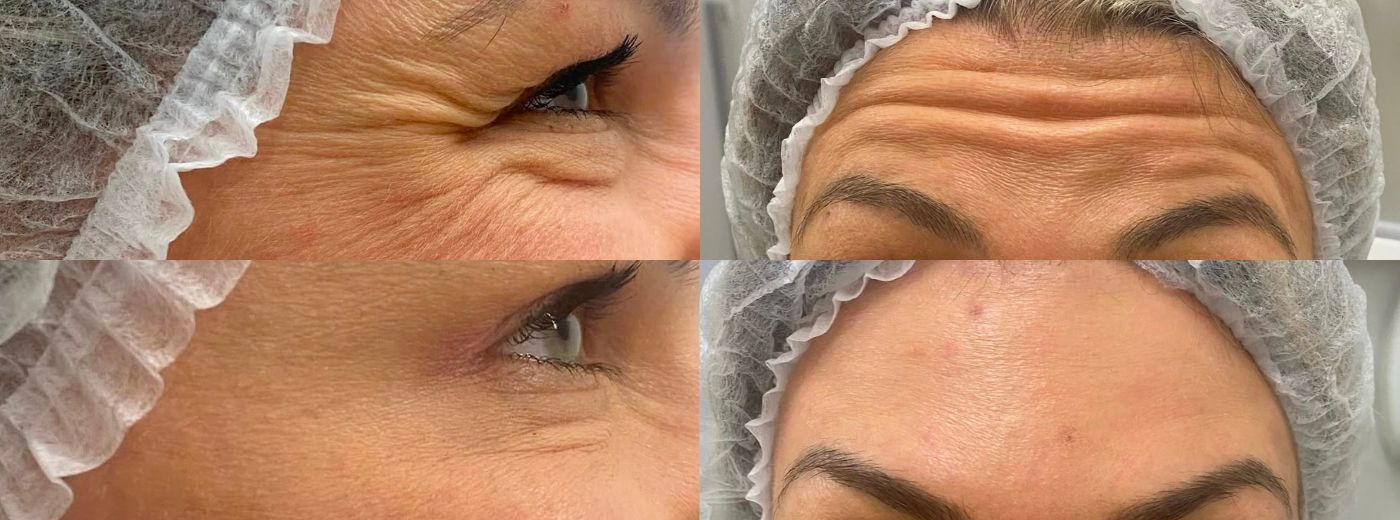 Aplicação de Toxina Botulínica para Testa + Olhos + Glabela + GANHE 4 Drenagens Linfáticas com método Renata França comprando até 30/06
