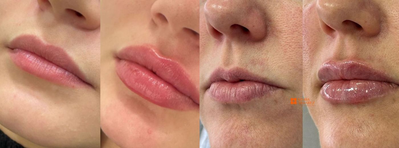 Mais Volume, com Naturalidade! Preenchimento com 1ml de Ácido Hialurônico para Lábios, Olheiras, Queixo OU Sulco Nasogeniano